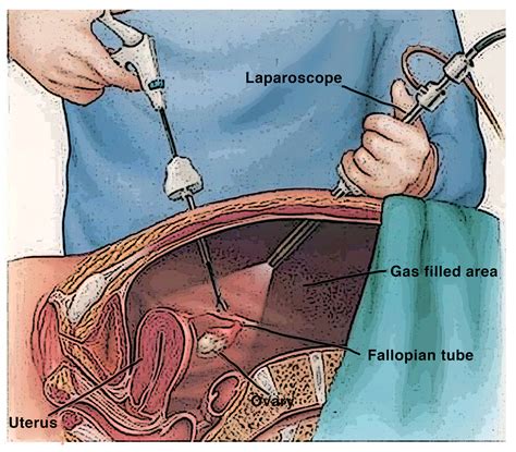 Laparoscopy Technique 